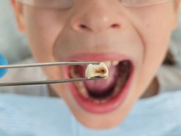 Best Emergency Dental Extractions in Waukegan, IL